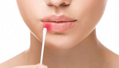 Герпес на губах: ознаки, лікування та профілактика