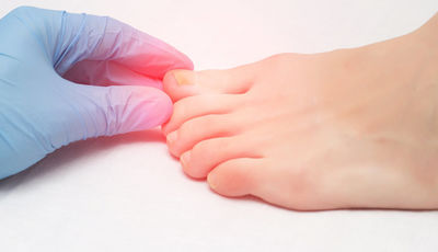 Як лікувати грибок нігтів?