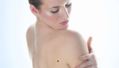 Меланома: як вчасно розпізнати рак шкіри?